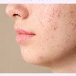 Atasi Jerawat dan Minyak Berlebih dengan 7 Rekomendasi Skincare Ini!. (Foto : Dok. Istimewa)